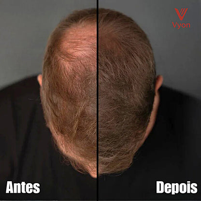 VYON™ – Preenchimento Capilar Invisível