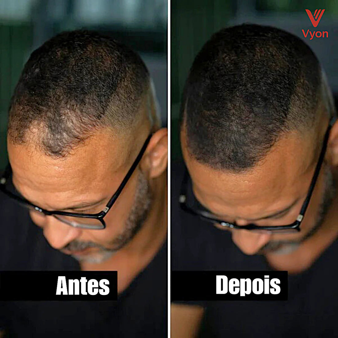 VYON™ – Preenchimento Capilar Invisível