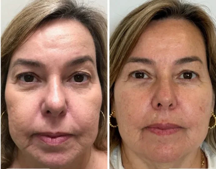 Collagen Fit™ – Máscara Lifting de Colagénio com Efeito Pele de Vidro